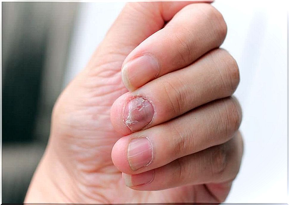 5 natural remedies for psoriasis on the nails