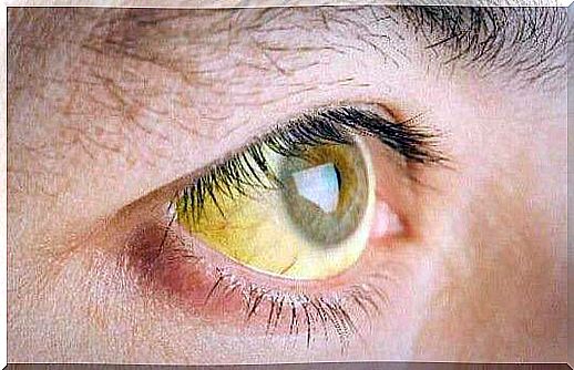 Jaundice due to vitamin deficiencies.