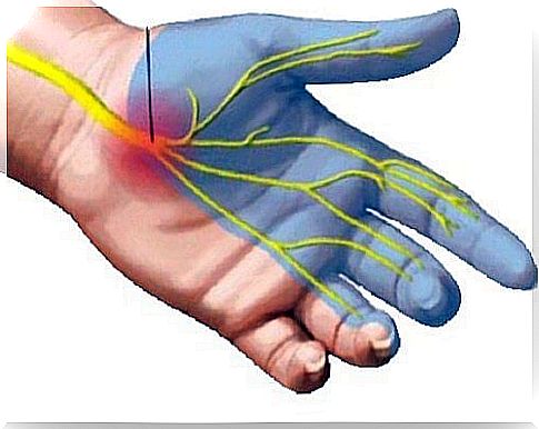 Carpal Tunnel Syndrome - 7 Pain Relieving Remedies