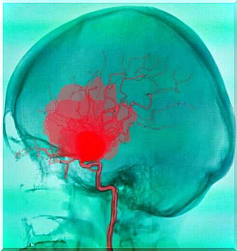 Cerebral palsy