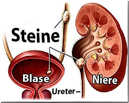 Kidney stones