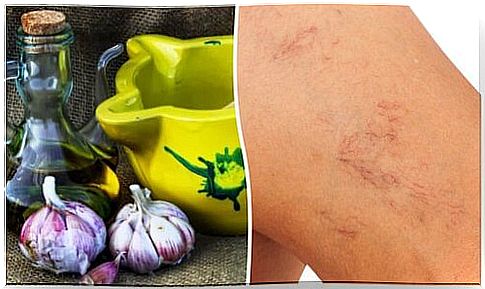 Fight varicose veins and spider veins with olive oil and garlic