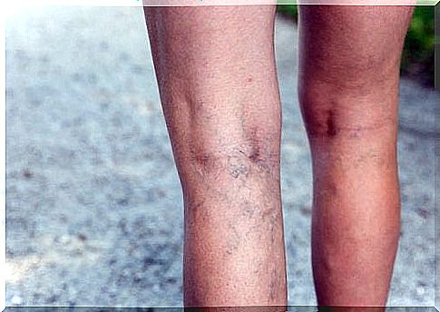 Varicose veins and broom riders