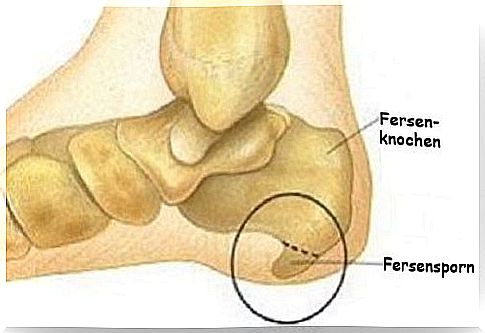 Heel spur;  Symptoms and Treatment Options