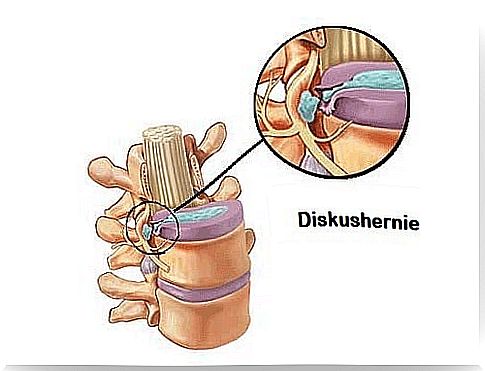 Herniated Disc - What Are The Symptoms?