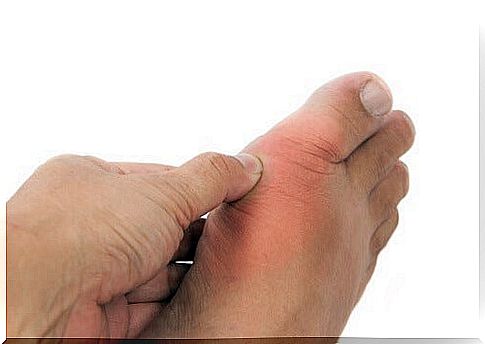 Home remedies for high uric acid levels and gout