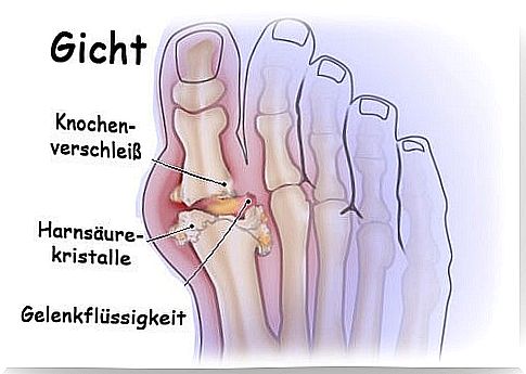 Foot damaged by gout