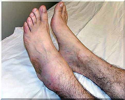 swollen ankle