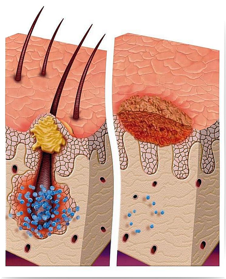 Multiple pilomatrixomas: what is it? 