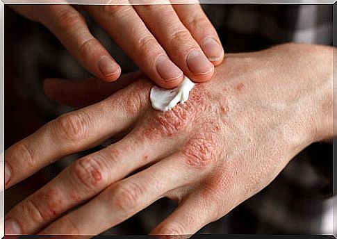 Lines on the nails due to psoriasis