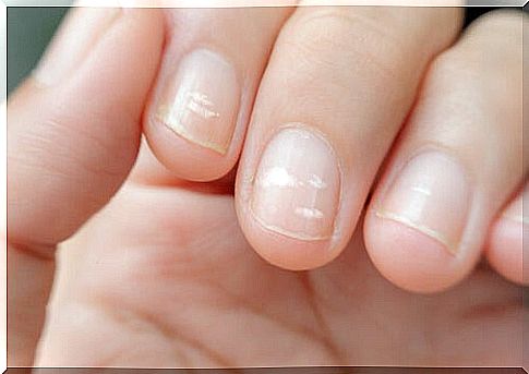 Lines on nails