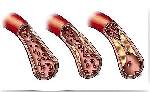 arteriosclerosis