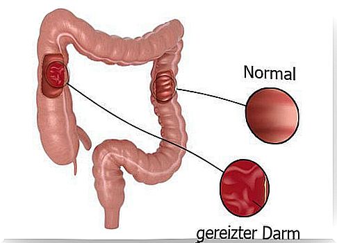 Recommended diet for irritable bowel syndrome