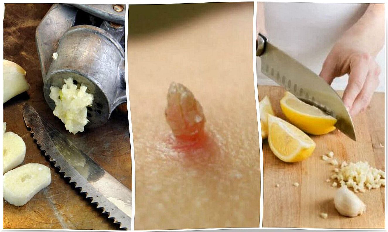 Warts Removal Using Natural Remedies