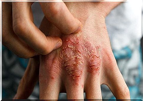 Treatment of psoriasis