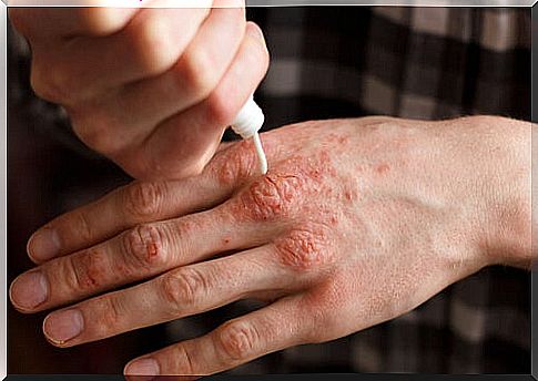 Applying the ointment for psoriasis