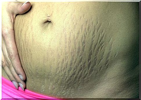 Stretch marks