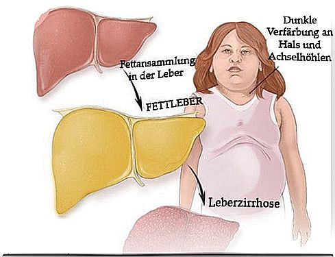 What can be done against fatty liver?