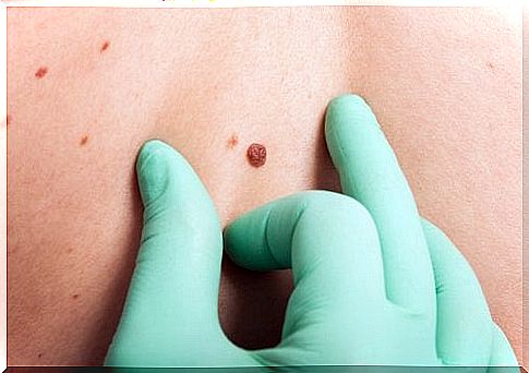 What is the ABCDE rule in skin cancer screening?