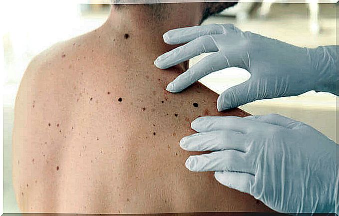 ABCDE rule to detect skin cancer