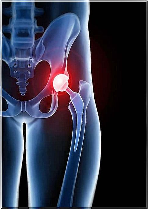 Trochanteric bursitis